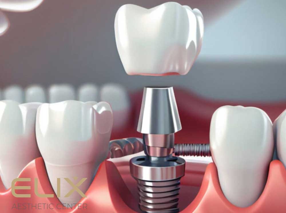 Dental implantation in Yerevan I Dentistry in Yerevan